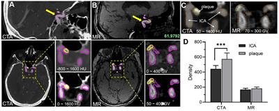 The Differentiation in Image Post-processing and 3D Reconstruction During Evaluation of Carotid Plaques From MR and CT Data Sources